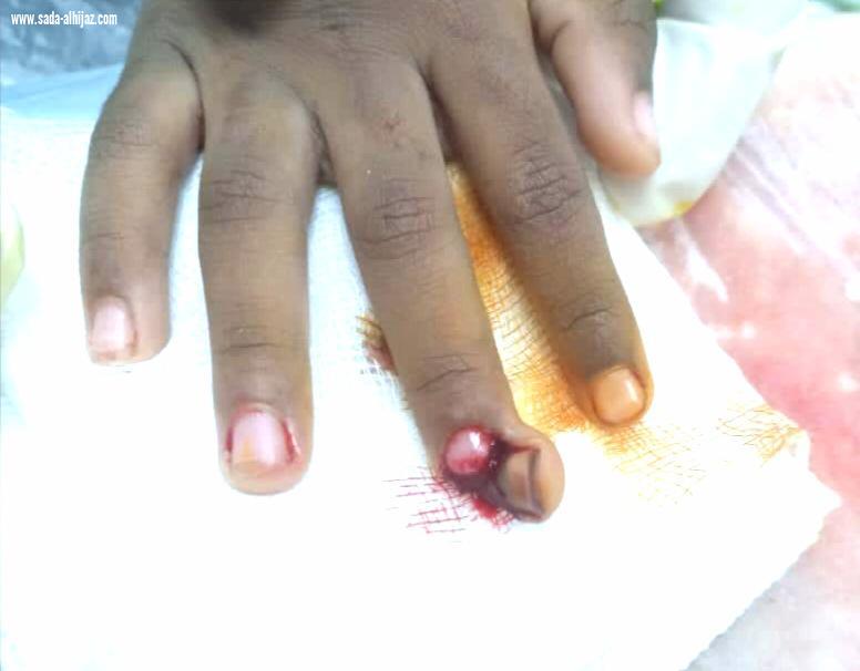 فريق طبي ينقذ طرف طفل من البتر بمستشفى ابو عريش العام