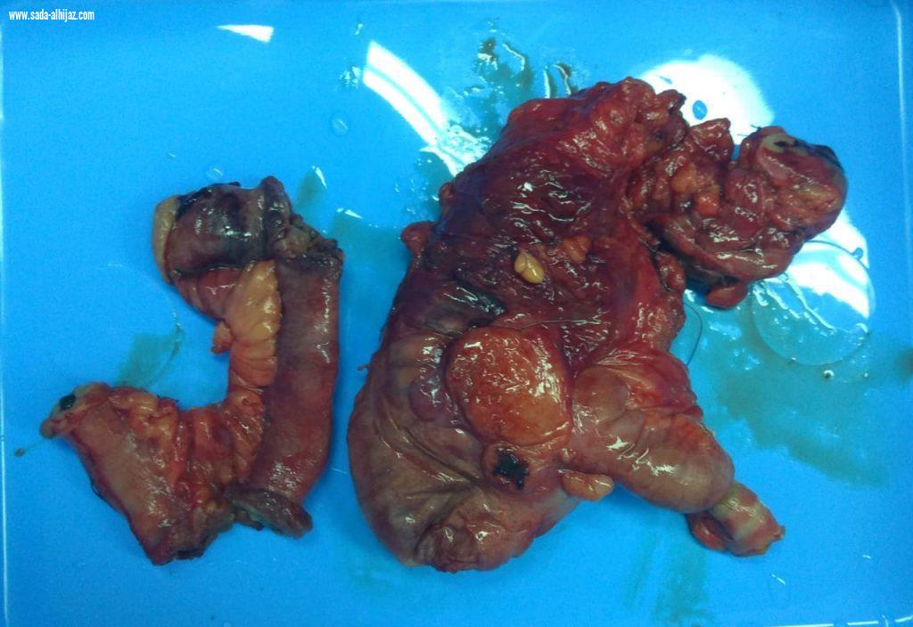 تدخل طبي عاجل لإنقاذ حياة ثلاثيني مصاب بنزيف داخلي حاد