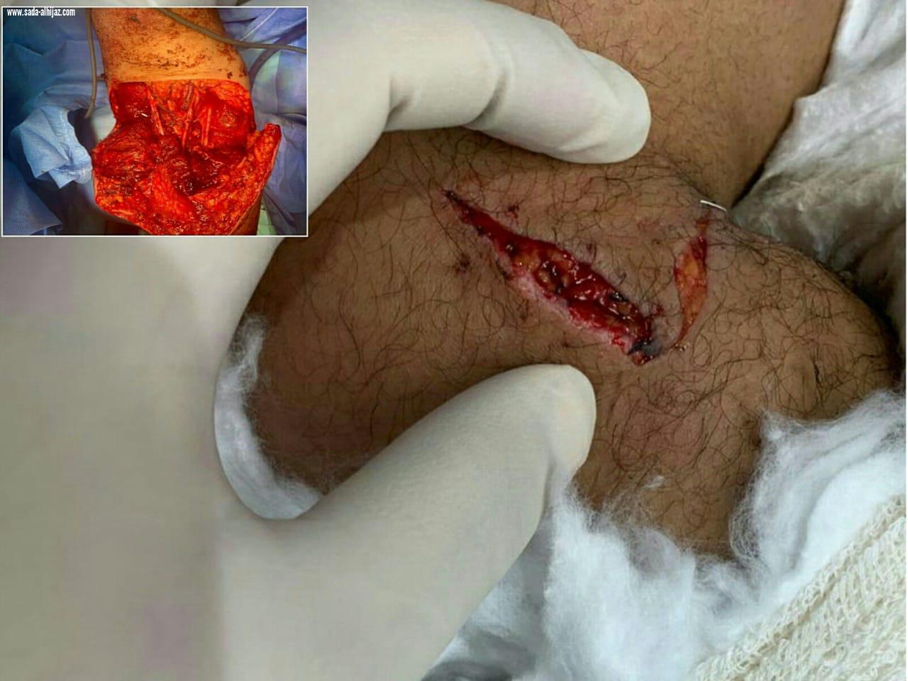 ثلاث فرق طبية  بمجمع الملك عبد الله تساعد في إعادة ذراع أربعيني