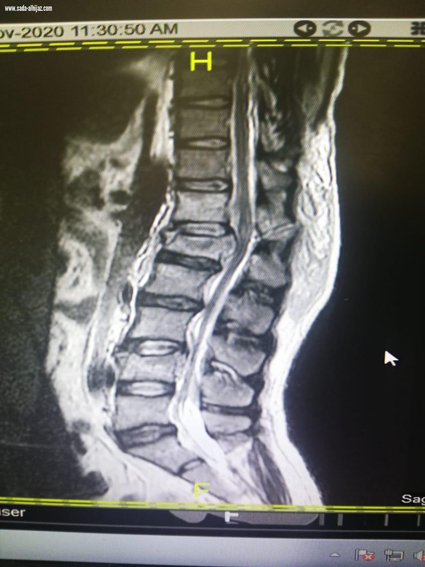 فريق طبي بمستشفى الملك عبدالعزيز يُنقذ حياة ثلاثيني سقط من الدور 5  
