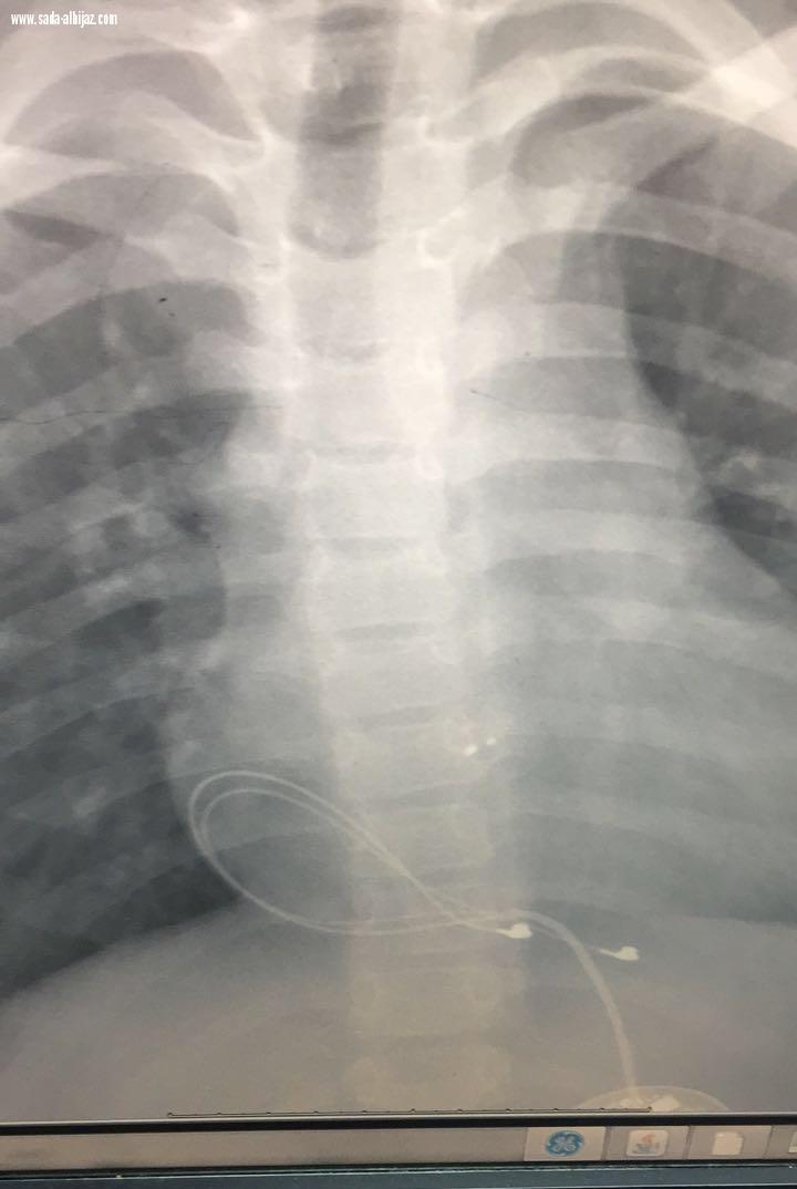 فريق طبي بمستشفى الولادة بمكة ينقذ حياة طفل اصيب بتباطؤ شديد في ضربات القلب