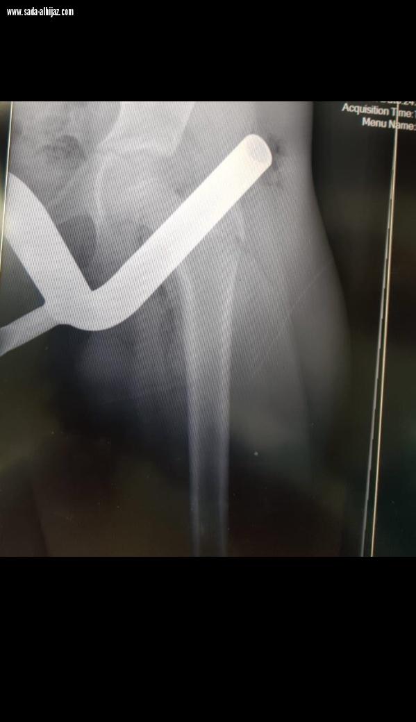 مستشفى الملك فهد بالمدينة ينجح بإخراج قطعة معدنية خرجت من دراجة هوائية و استقرت بفخذ شاب .