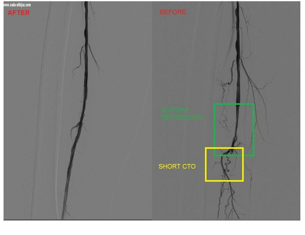 مجمع الملك عبد الله ينجح في معاناة أربعيني في أزلة الجلطات