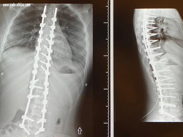 إنهاء معاناة مريضين من إنحناء للعمود الفقري في بيشة 