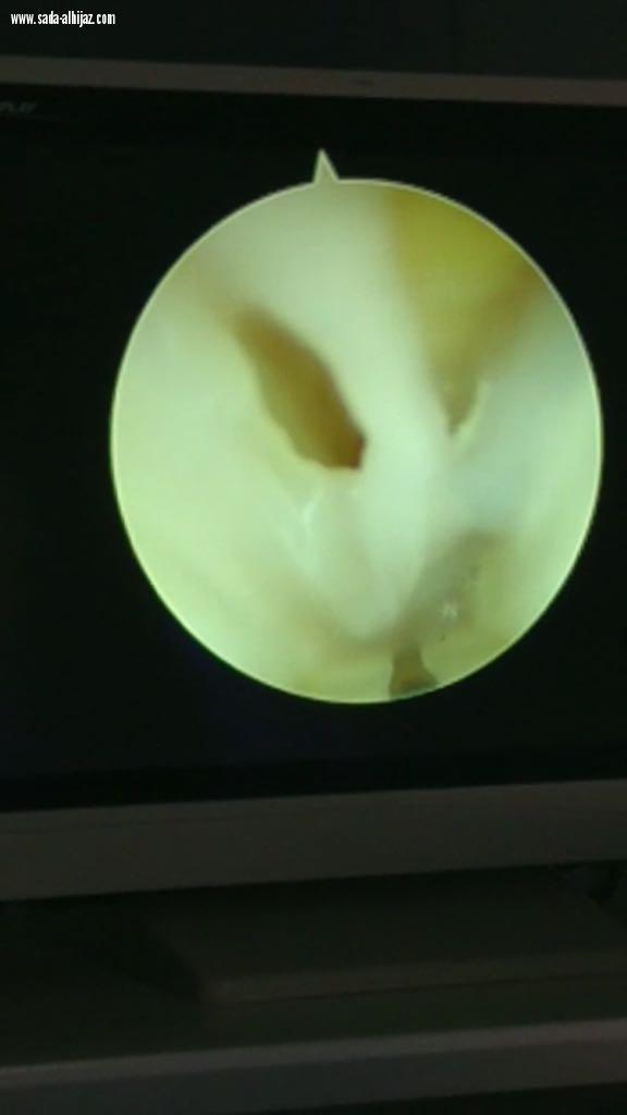 متلازمة النفق الرسغي بإستخدام المنظار بمستشفى الملك عبدالعزيز بمكة