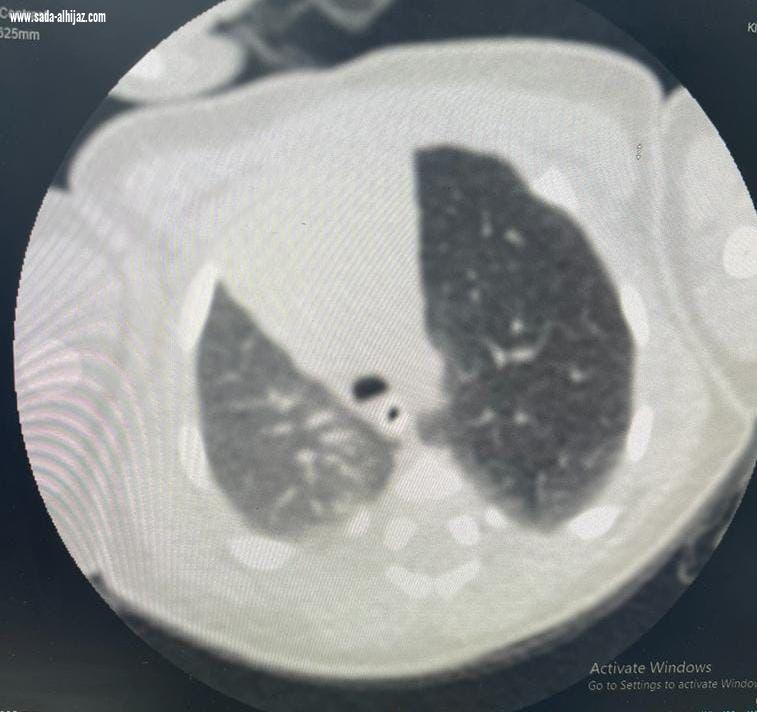 لأول مرة بالطائف .. جراحة صدر لـ 