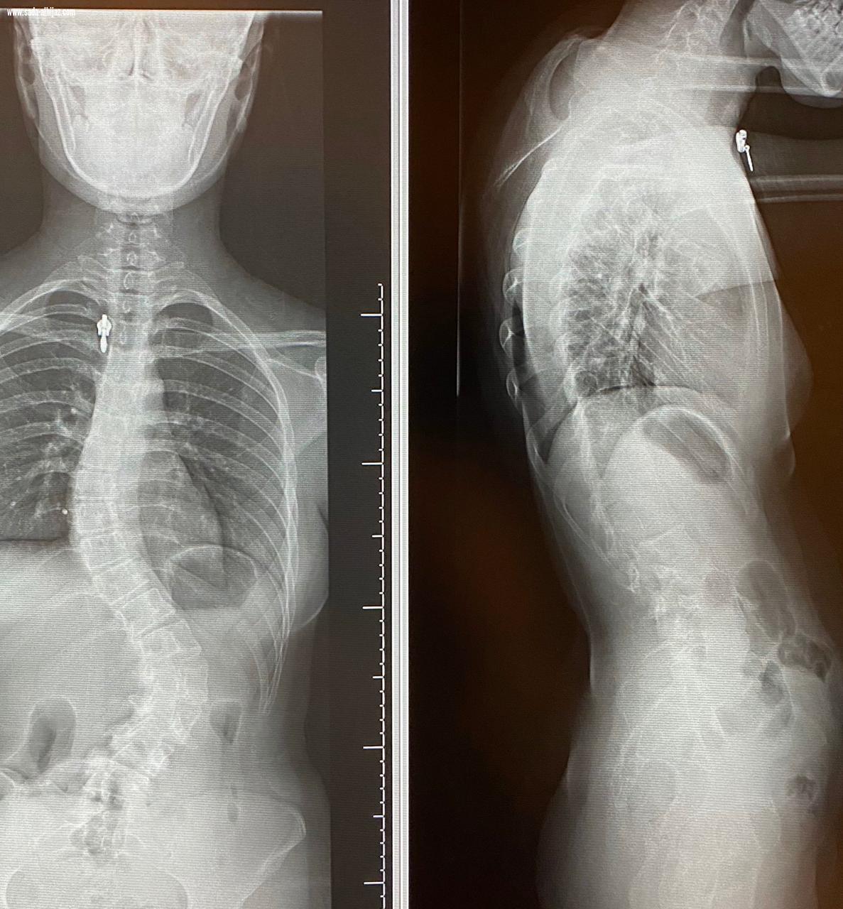 إنهاء معاناة مريضين من إنحناء للعمود الفقري في بيشة 