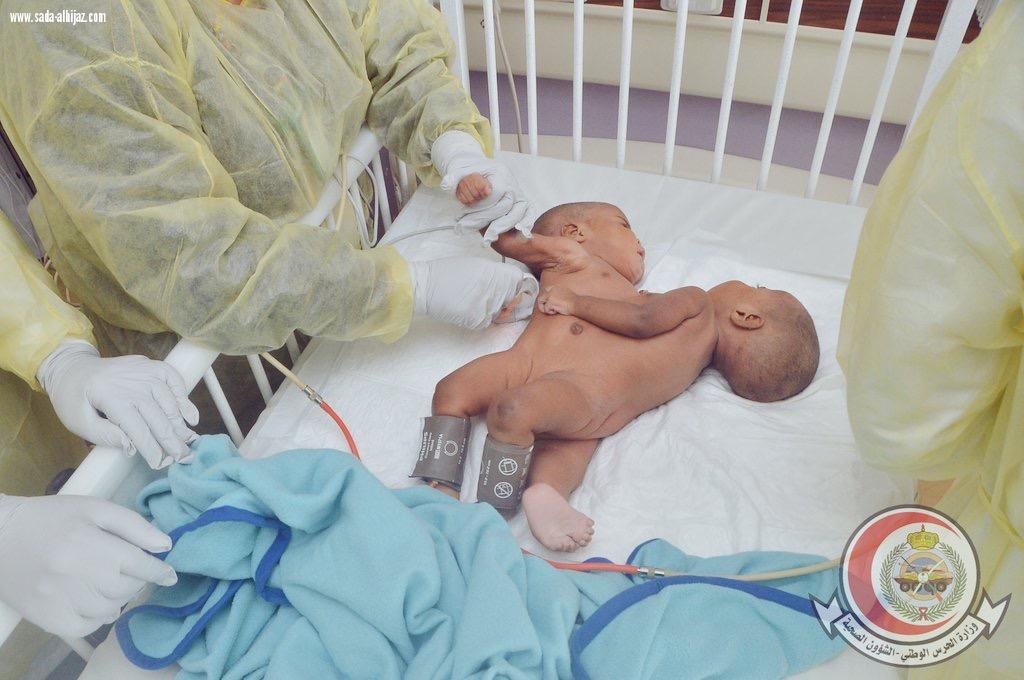 انفاذا لتوجيهات خادم الحرمين الشريفين حفظه الله  وصول التوأم السيامي التنزاني انيسيا وملينيس لمدينة الملك عبدالعزيز الطبية بالرياض