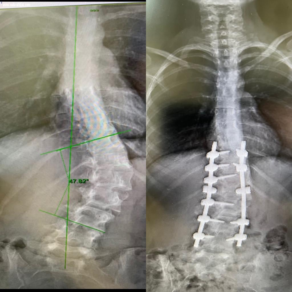 إنهاء معاناة فتاة تبلغ من العمر 20 سنة  كانت تعاني من تقوس بالعمود الفقري بمستشفى الملك فهد بجدة