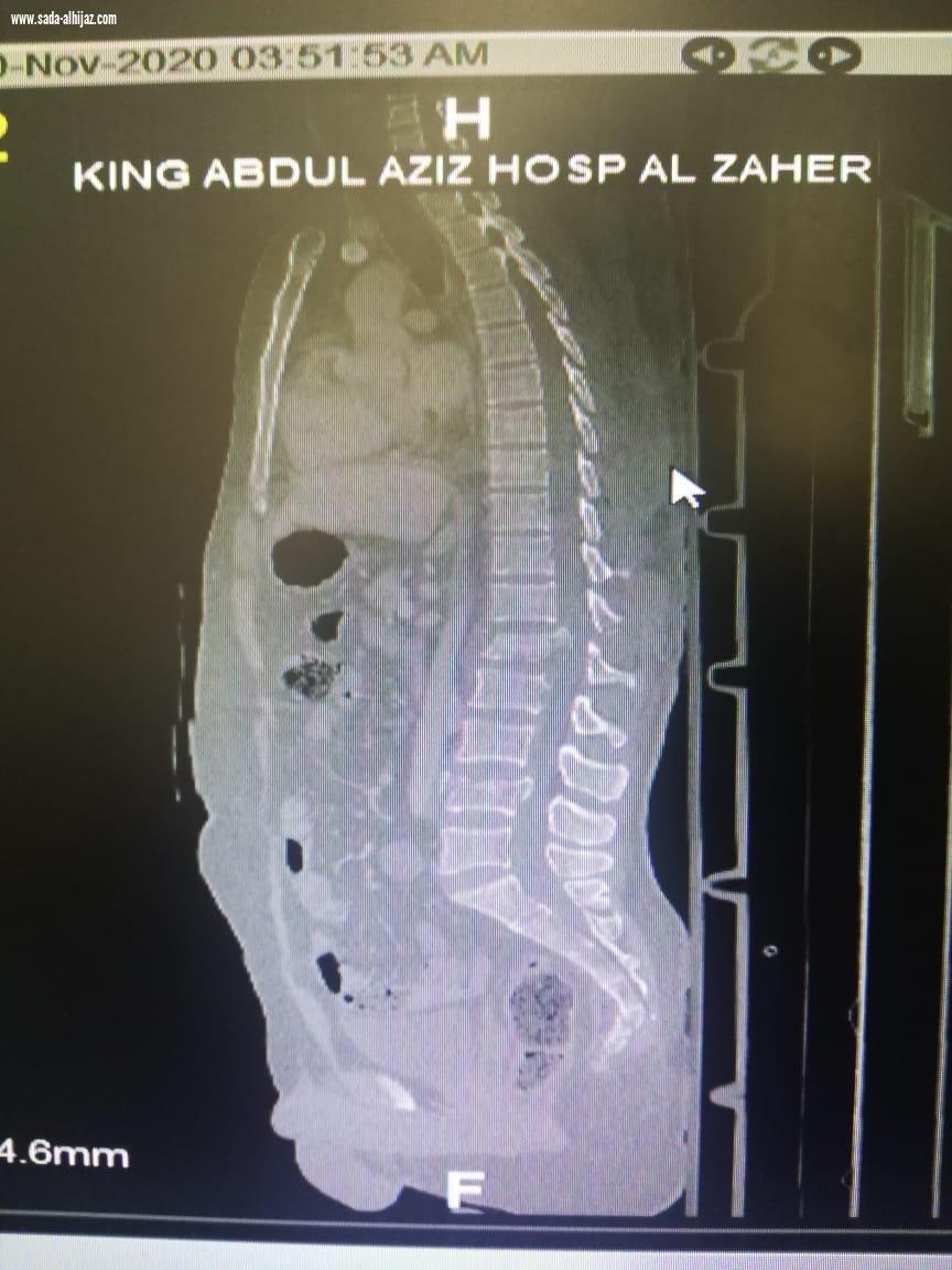 فريق طبي بمستشفى الملك عبدالعزيز يُنقذ حياة ثلاثيني سقط من الدور 5  