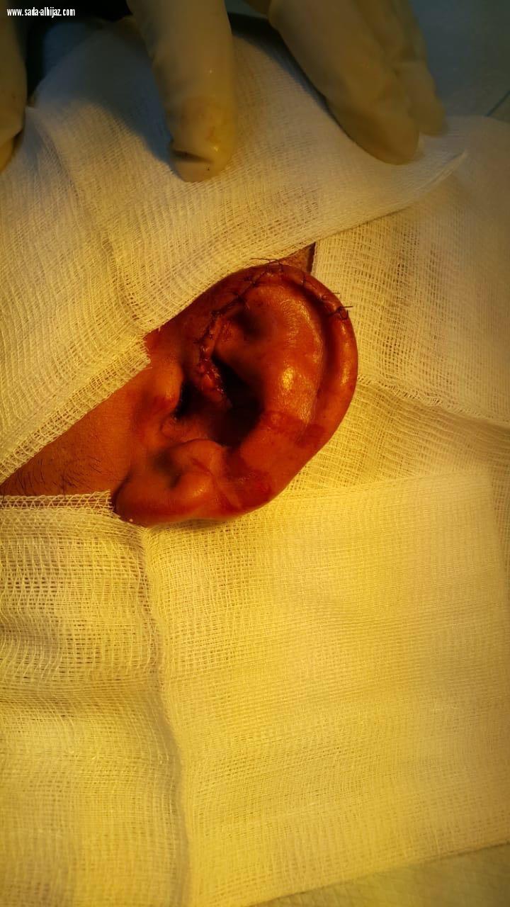 في مستشفى المهد:  إعادة السمع لشاب تعرض لحادث سير ..