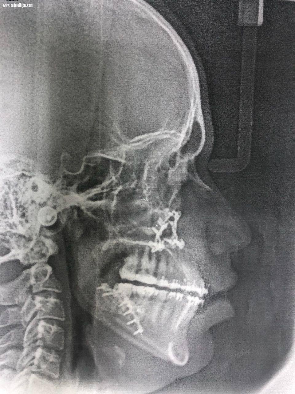 تشكيل فريق طبي لمواجهة التشوهات الخلقية للفكين بمستشفى الملك فهد بالمدينة ونجاح 7 عمليات