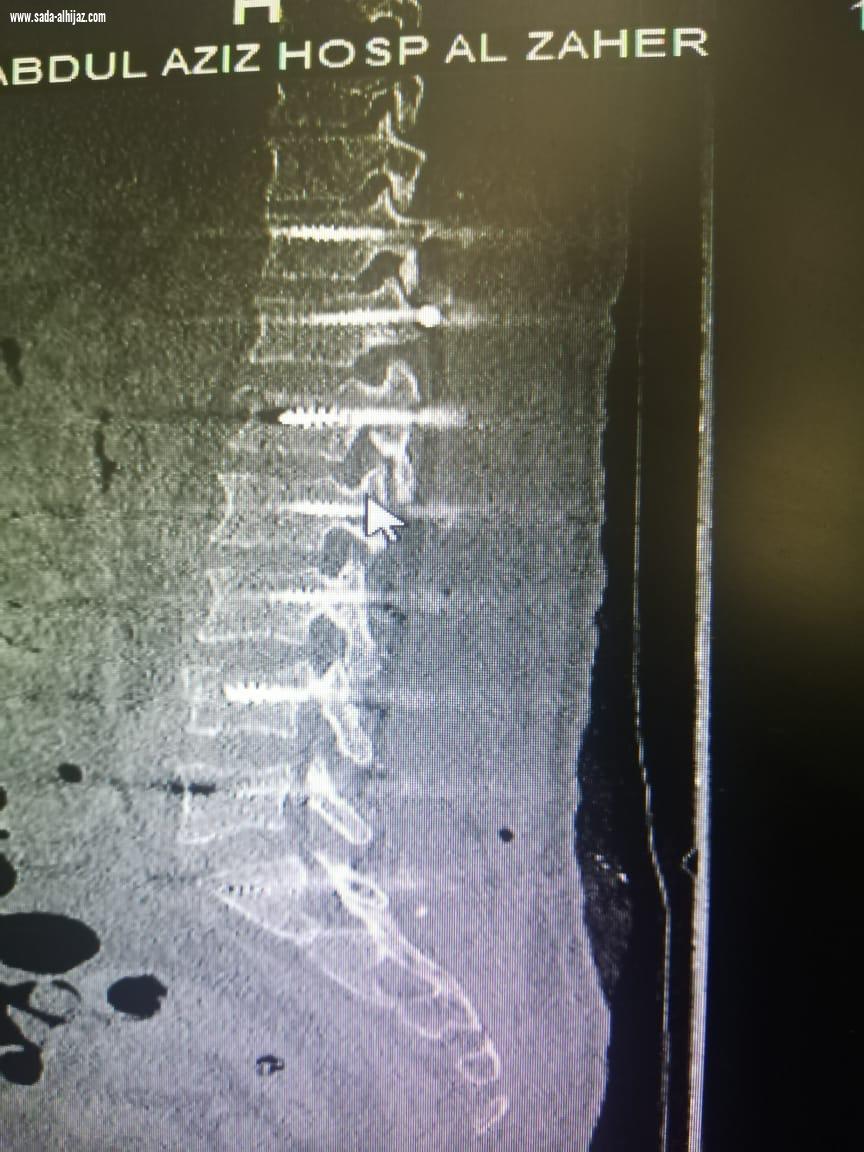 فريق طبي بمستشفى الملك عبدالعزيز يُنقذ حياة ثلاثيني سقط من الدور 5  