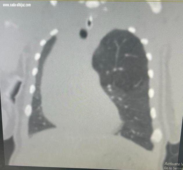 لأول مرة بالطائف .. جراحة صدر لـ 
