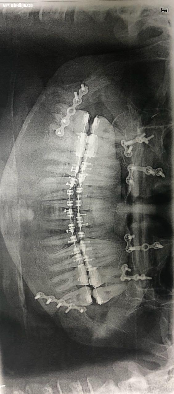 تشكيل فريق طبي لمواجهة التشوهات الخلقية للفكين بمستشفى الملك فهد بالمدينة ونجاح 7 عمليات
