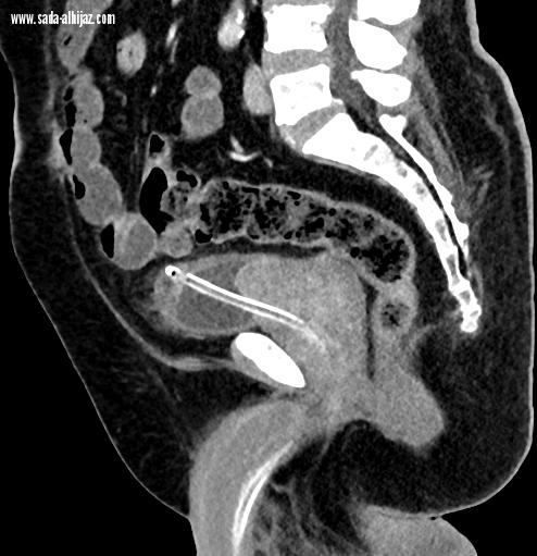 خدمة طبية جديدة لعلاج تضخم البروستات بمستشفى النور التخصصي