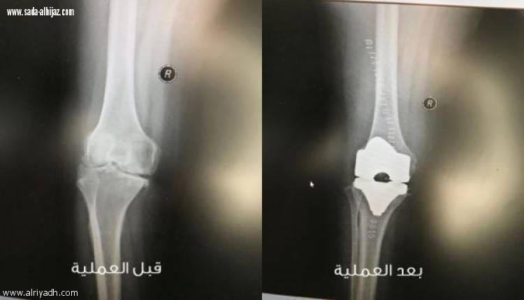 نجاح إستبدال مفصل لخمسينية في نستشفى الامير متعب في سكاكا 
