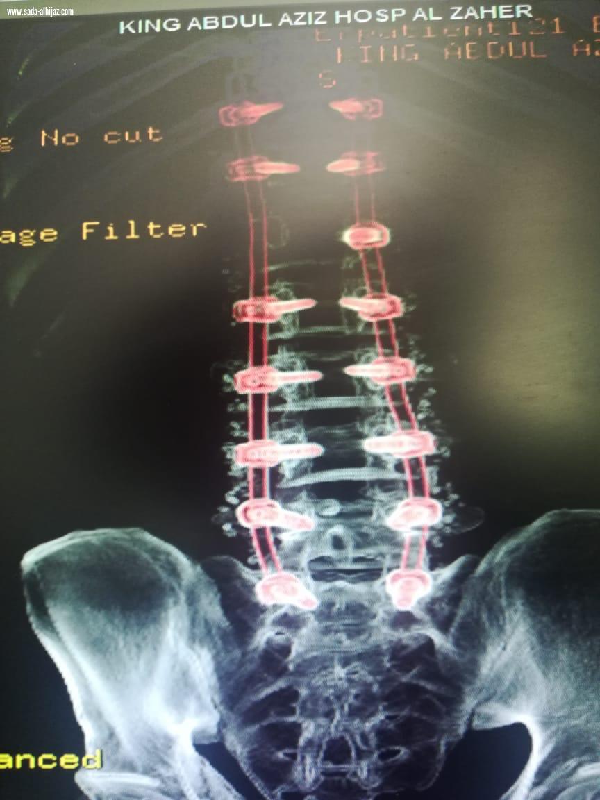 فريق طبي بمستشفى الملك عبدالعزيز يُنقذ حياة ثلاثيني سقط من الدور 5  