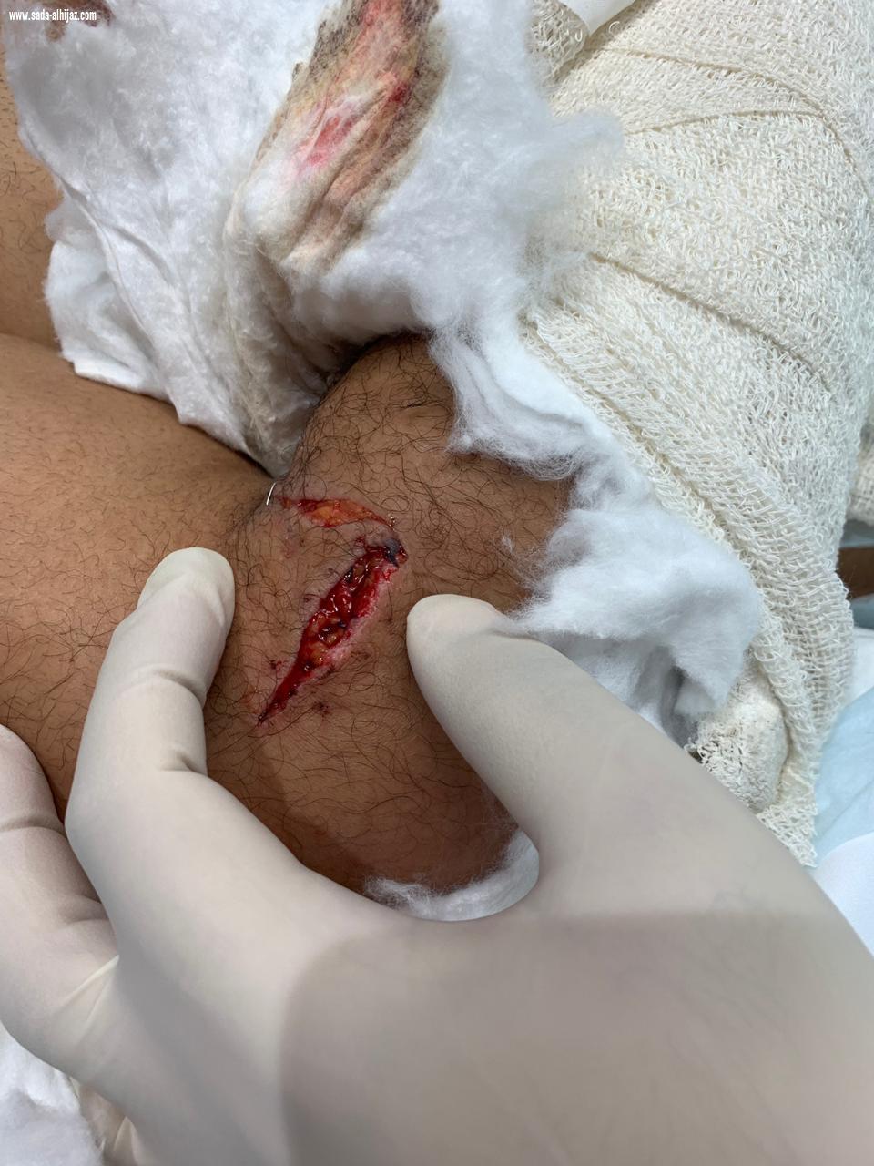 ثلاث فرق طبية  بمجمع الملك عبد الله تساعد في إعادة ذراع أربعيني