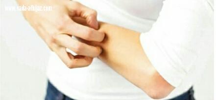 استشاري الجرب يمكن أن يصيب النظيفين وهو غير مخيف والعلاج في 3 أيام 