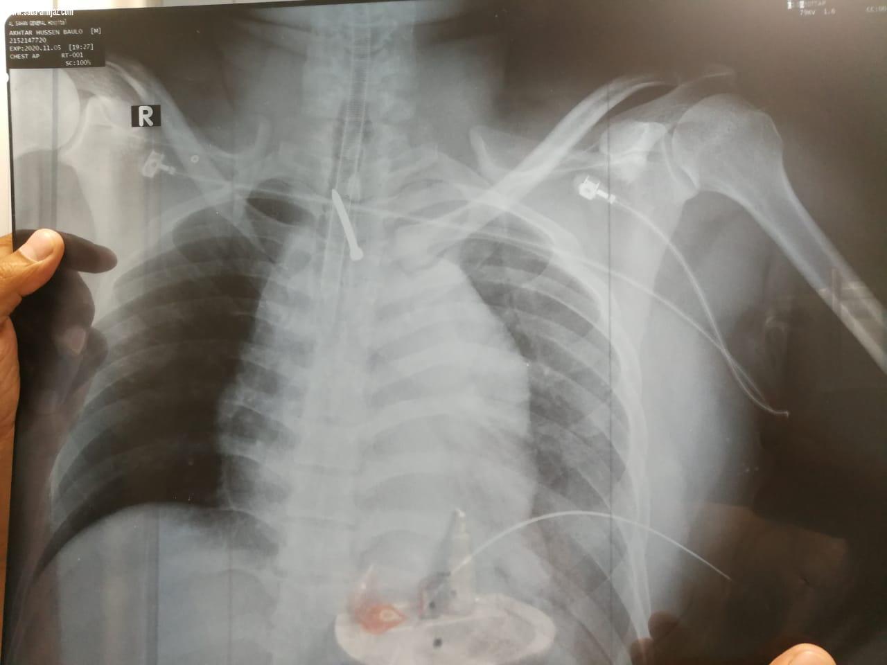 إصابات الشريان الأورطي عادة تؤدي للوفاة التدخل الطبي بتخصصي الطائف ينجح في إنقاذ حياة عامل أصيب بمسمار بالشريان الأورطي