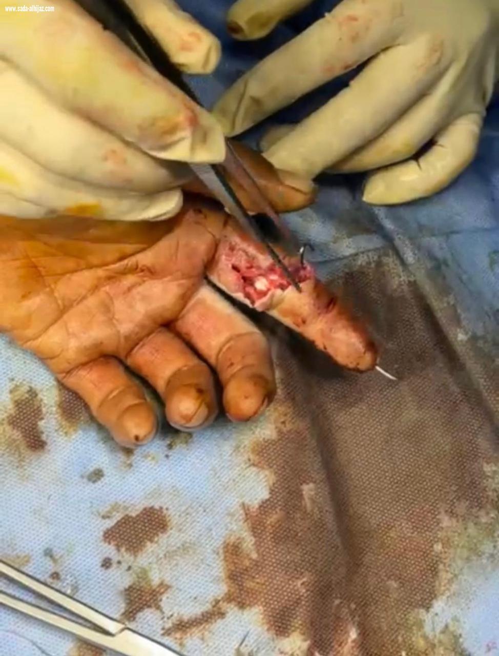 عملية الثلاث ساعات تنقذ أصبع عامل من البتر بجدة