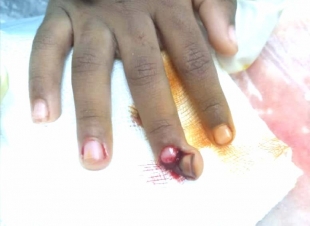 فريق طبي ينقذ طرف طفل من البتر بمستشفى ابو عريش العام