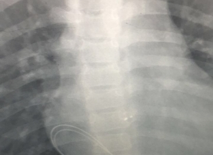 فريق طبي بمستشفى الولادة بمكة ينقذ حياة طفل اصيب بتباطؤ شديد في ضربات القلب