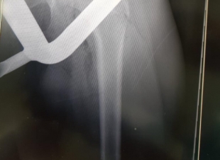 مستشفى الملك فهد بالمدينة ينجح بإخراج قطعة معدنية خرجت من دراجة هوائية و استقرت بفخذ شاب .