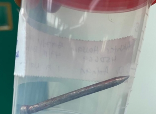 إصابات الشريان الأورطي عادة تؤدي للوفاة التدخل الطبي بتخصصي الطائف ينجح في إنقاذ حياة عامل أصيب بمسمار بالشريان الأورطي