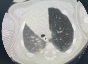 لأول مرة بالطائف .. جراحة صدر لـ 