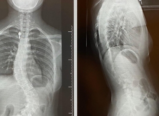 إنهاء معاناة مريضين من إنحناء للعمود الفقري في بيشة 
