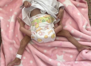 إنفاذًا لتوجيهات خادم الحرمين الشريفين.. إجراء عملية فصل التوأم الطفيلي اليمني عائشة غدًا