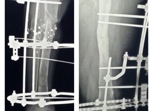 عمليتان نوعيتان لتعويض العظام المفقودة لشابين في جازان