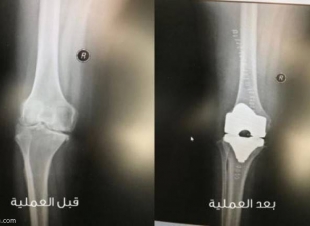 نجاح إستبدال مفصل لخمسينية في نستشفى الامير متعب في سكاكا 